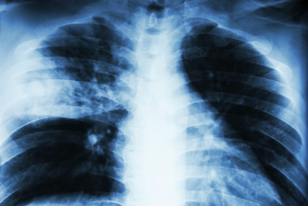 Pneumonia