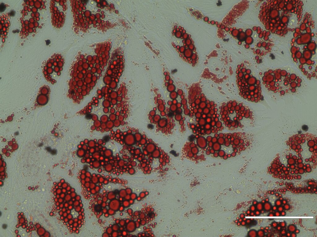 Humane braune Adipozyten, rot gefärbtes Lipid (Oil Red O-Färbung)